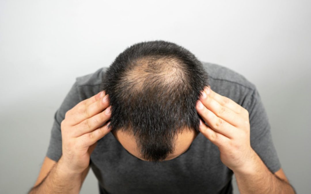 Lze zastavit vypadávání vlasů? Nevěřte mýtu, že padání se dědí z matčiny strany